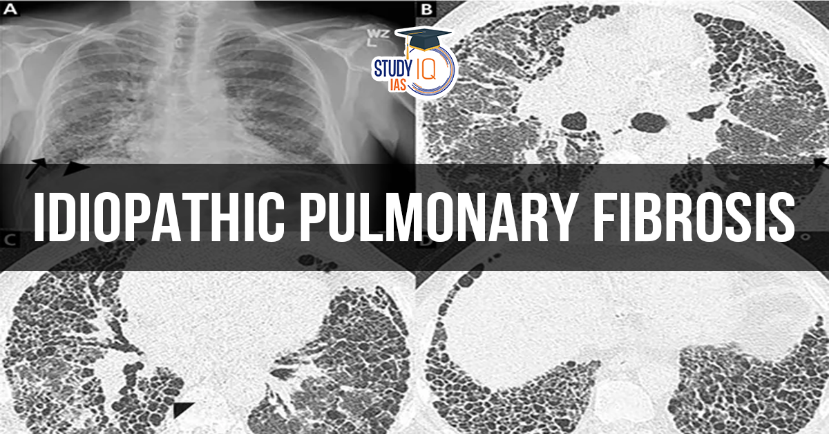 Idiopathic pulmonary fibrosis (blog)