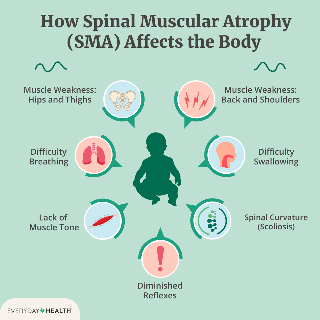 Spinal Muscular Atrophy (SMA)1