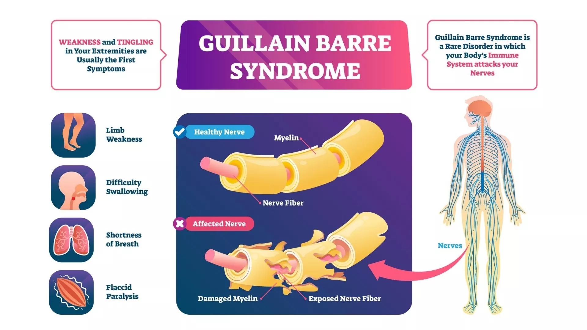 Guillain-Barré Syndrome (GBS)